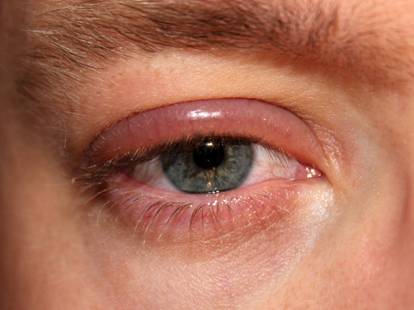Lower Eyelid Redness And Itchy